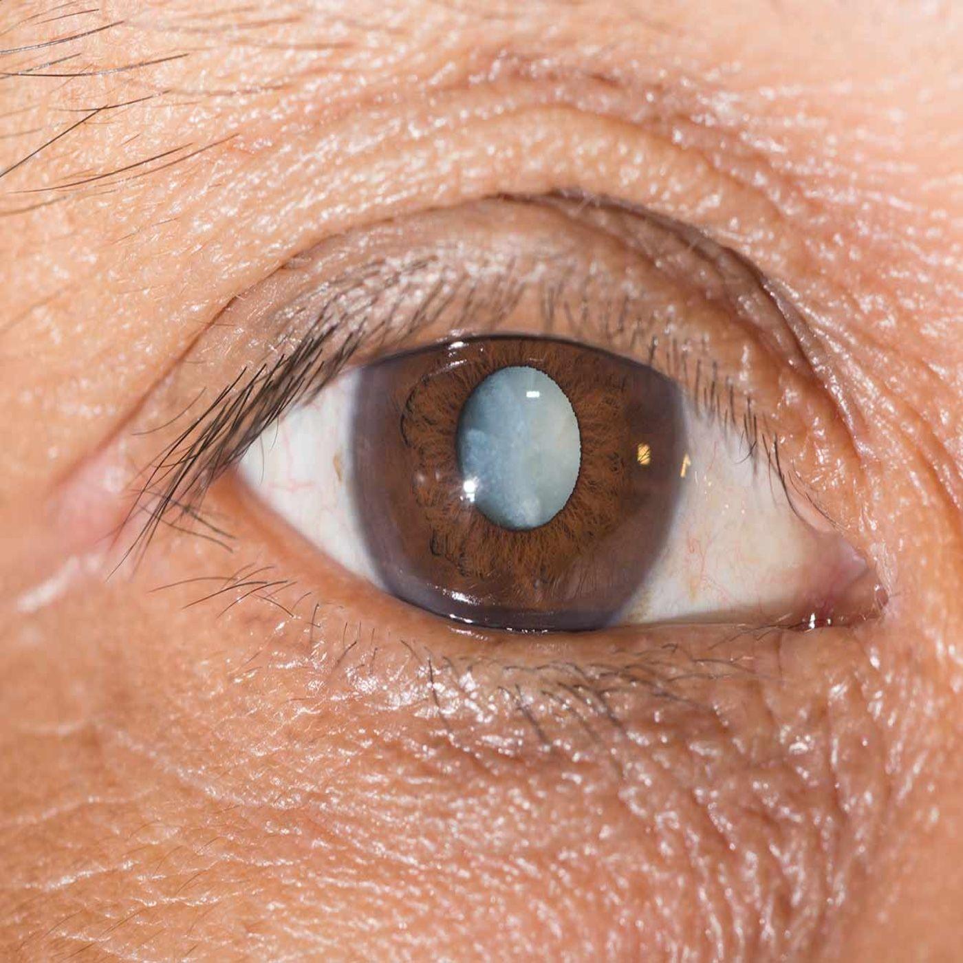Cataracts and alternatives to surgery! Your DIY Health Natural